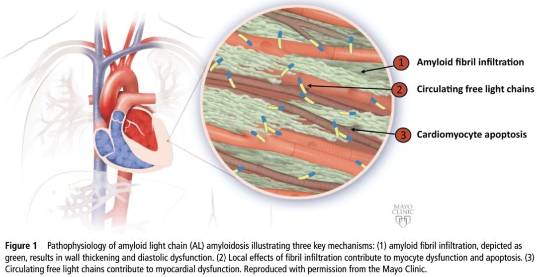 陈良华教授限制型心肌病发病机制