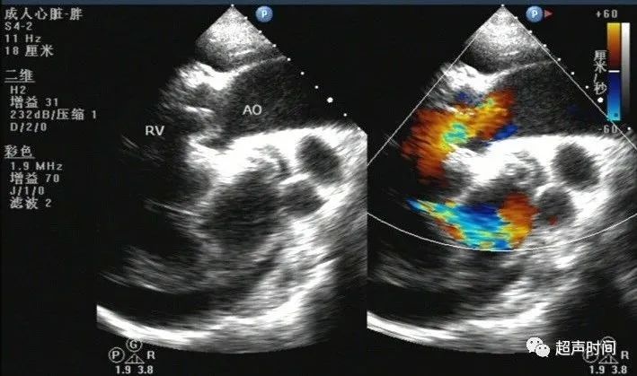 容易被漏诊的矫正型大动脉转位