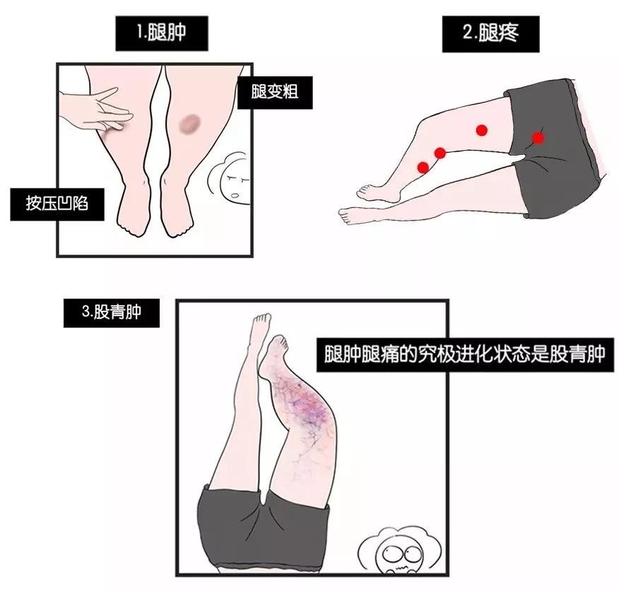 最严重的情况会导致股青肿,股白肿,这是由于静脉回流严重受阻,导致患