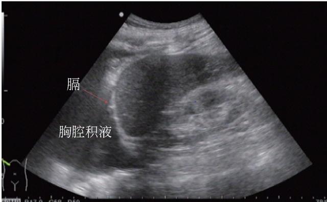 超声胸腔积液上下径图图片