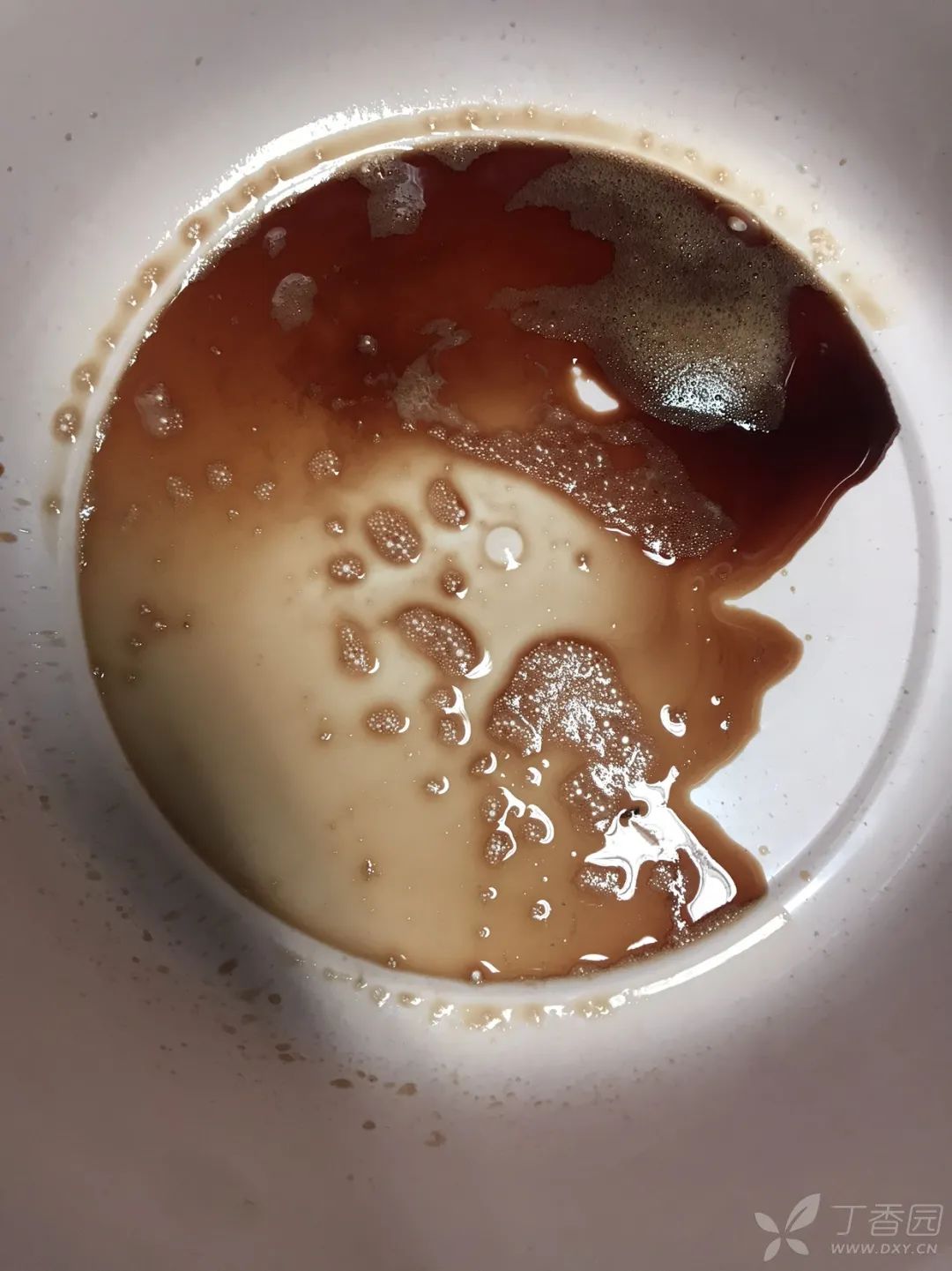 入院后胸水从黄色变成酱油色你的判断是什么