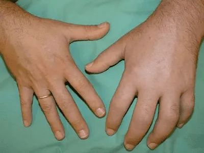 可见于多种疾病,中风后发生于上肢者又常称为肩手综合征