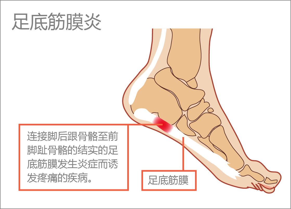 足底筋膜炎跟腱指足跟部的带状肌腱纤维,跟腱炎就是跟腱急慢性劳损后