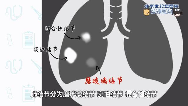 【科普动画】肺结节不等于肺癌_肿瘤