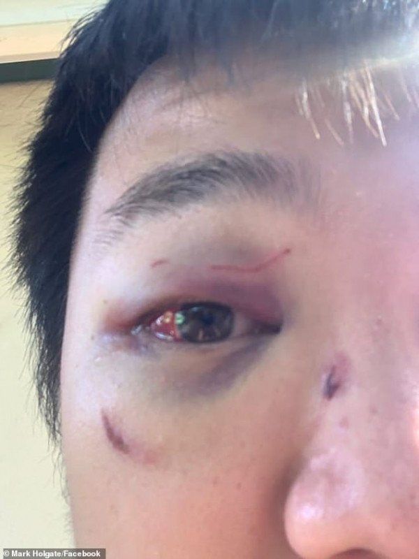 澳中国留学生当街被打只因没讲英文颧骨骨折可能失明比病毒蔓延更快的