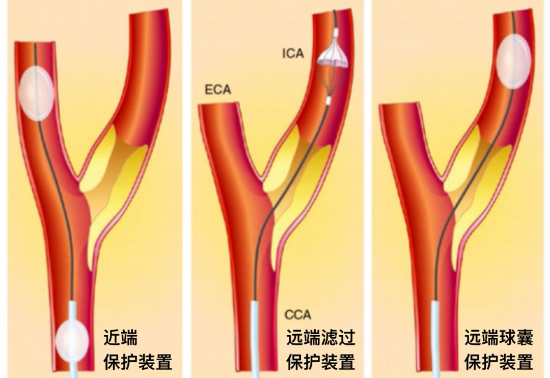 颈动脉支架示意图图片