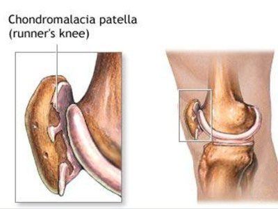 星61知识髌骨软骨软化症与运动注意事项