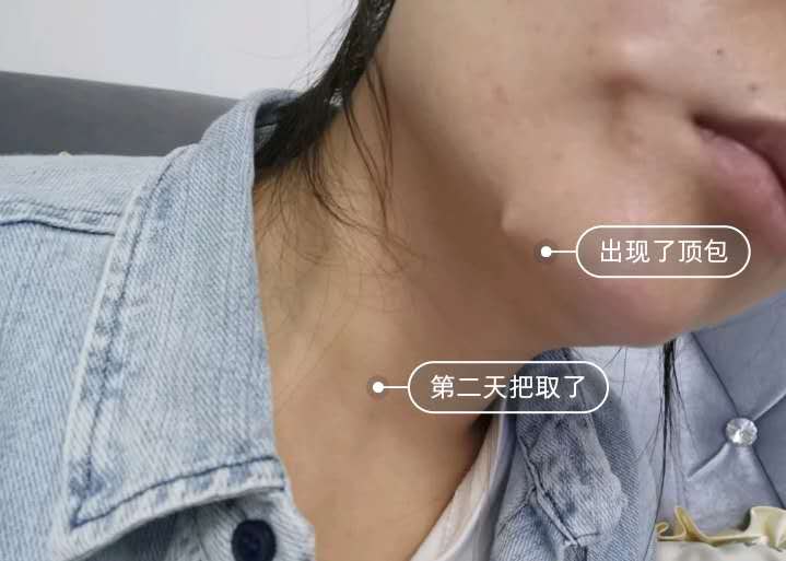 听着线雕的原理我相信每个女人都会心动,可是我做完线雕后半个多月