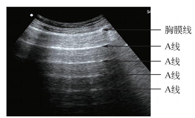 (1)a线: b型超声下可见胸膜线后方多条等距的回声强度逐渐减低的与