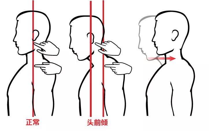 长期坐电脑习惯头前伸样子猥琐还影响健康