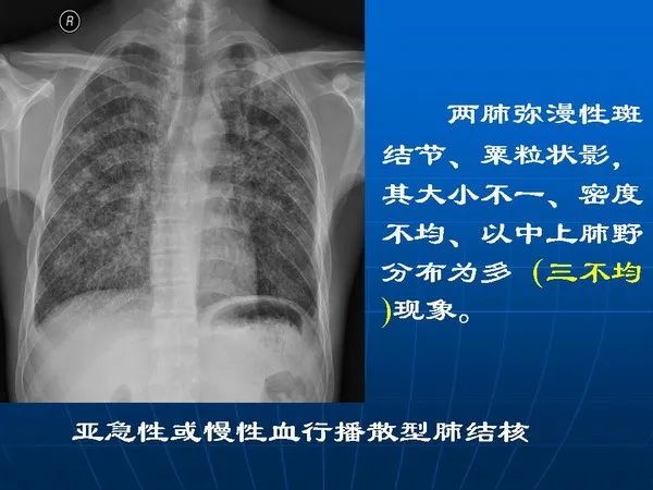 肺结核x光片图片