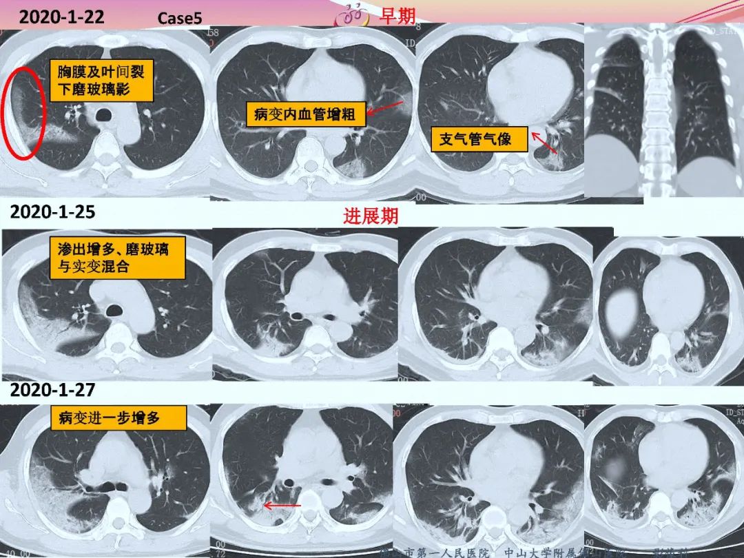 ct室对新型冠状病毒肺炎的应对策略及影像诊断分析