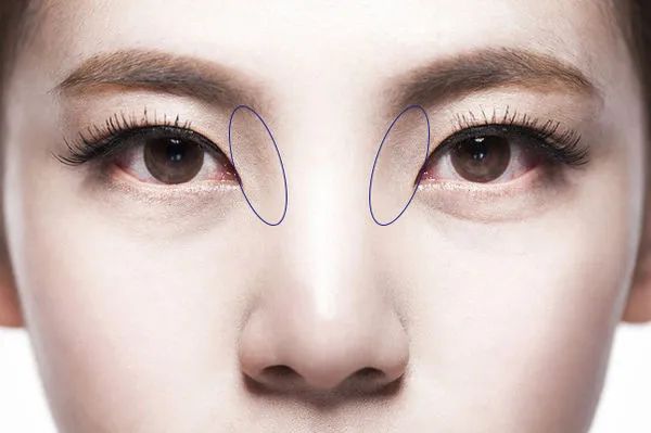 此时,山根,眉头和内眼角凹进去的部分,我们称它为"面部黄金窝".