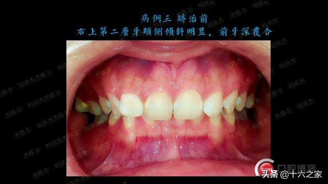 三例上颌磨牙颊侧倾斜引起正锁颌的矫治策略