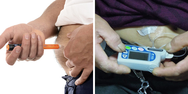 天泰小讲堂之二胰岛素泵的适用人群与药物选择