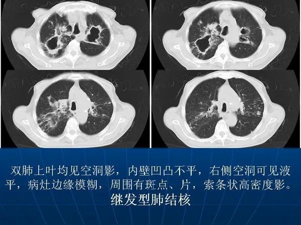 各型肺结核的典型影像表现