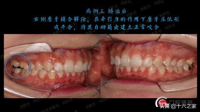 三例上颌磨牙颊侧倾斜引起正锁颌的矫治策略