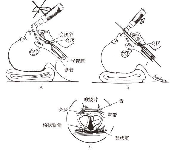 犬气管插管声门示意图图片