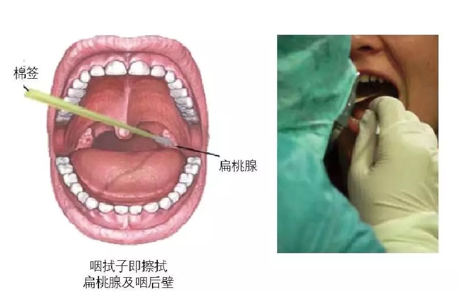 新型冠状病毒检测标本——鼻咽拭子采样方法