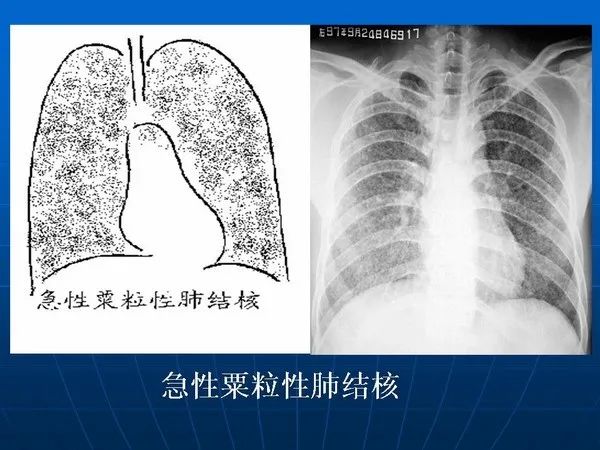 肺结核哑铃状x线图片图片