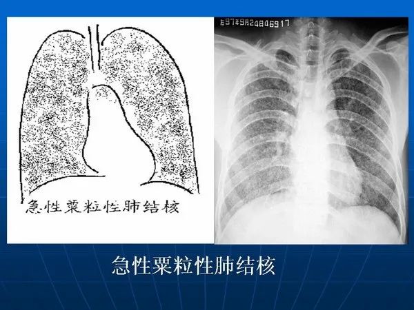 各型肺结核的典型影像表现