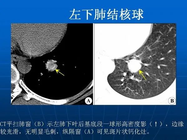 各型肺结核的典型影像表现