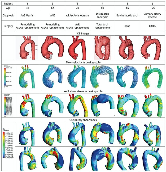 图8 baa患者计算机流体动力学分析(aae: annuloaortic ectasia; as