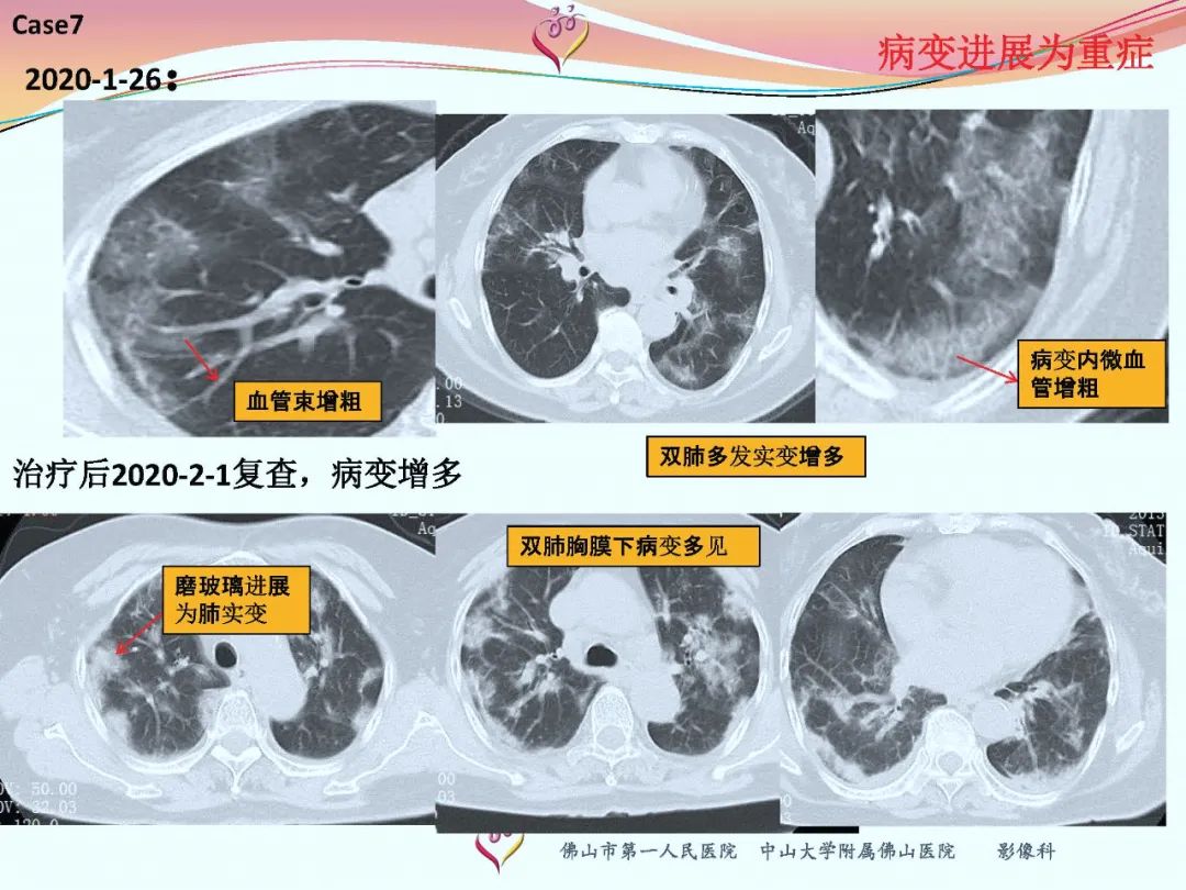 ct室对新型冠状病毒肺炎的应对策略及影像诊断分析