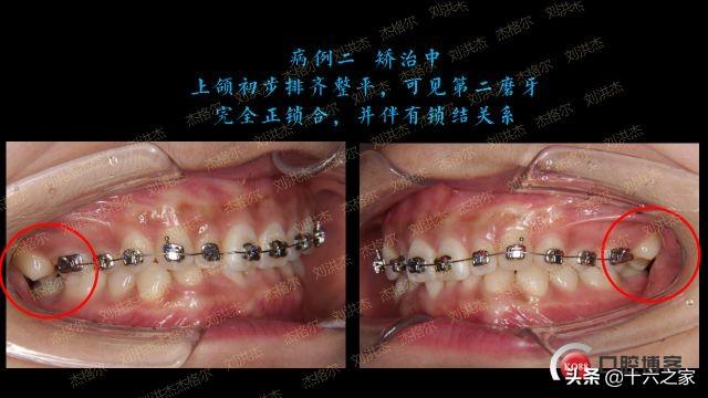 三例上颌磨牙颊侧倾斜引起正锁颌的矫治策略