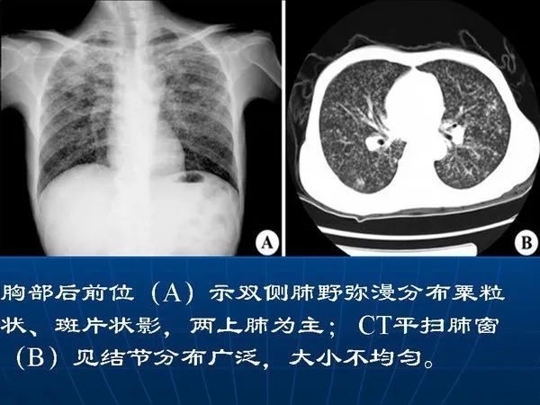 各型肺结核的典型影像表现