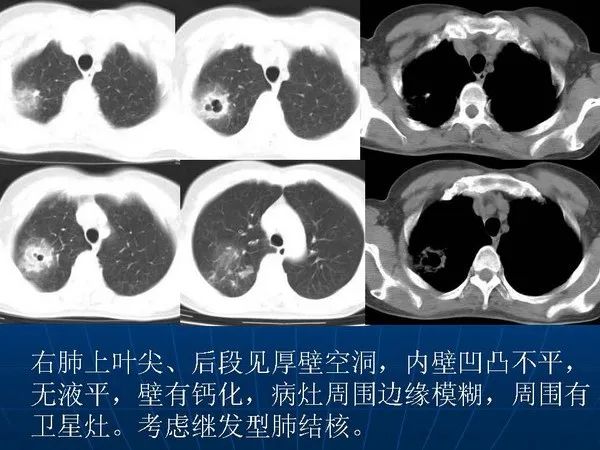 肺结核ct影像表现图解图片
