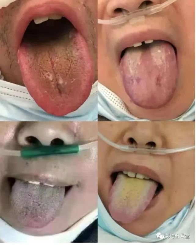 新冠肺炎中医如何解读疫情当前中医怎样应对战疫情我们在行动一