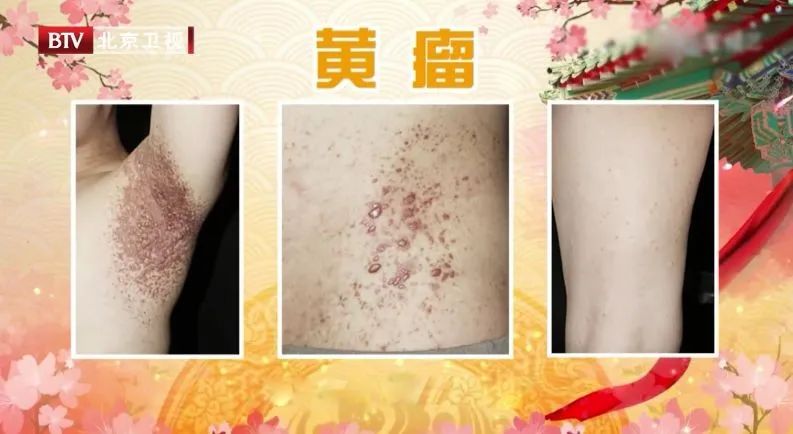 可以导致粥样硬化,血管病,心脏病,胰腺炎等多种疾病,因此如果出现黄瘤