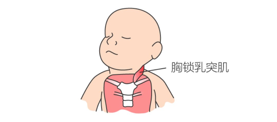 可以用按摩宝宝脖子肌肉紧张(摸起来较硬)一侧的胸锁乳突肌来缓解