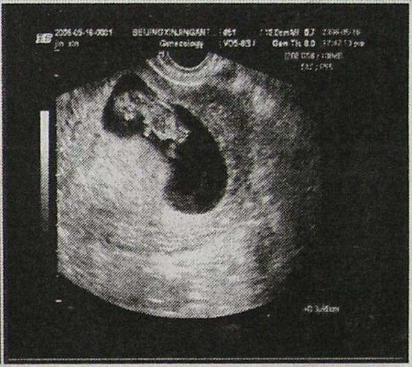 怀孕35天胎儿图片 真实图片