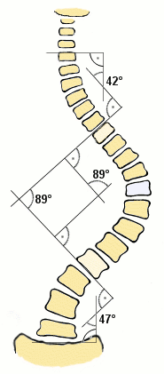 脊柱侧弯cobb角分级图片