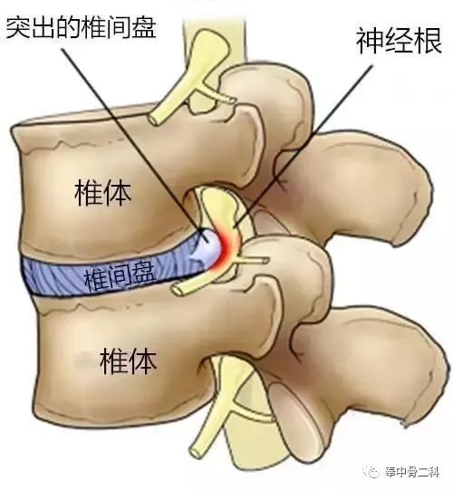 神经根型颈椎病