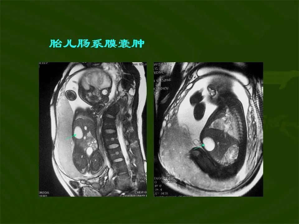 胎儿肠系膜囊肿图片