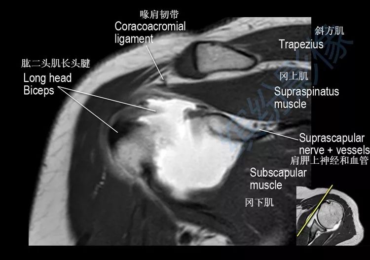 肩關節斜冠狀面mr斷層解剖