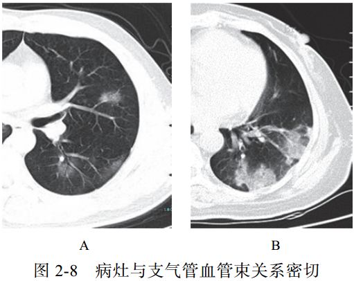 病毒肺炎病灶常沿着间质分布蔓延(图 2