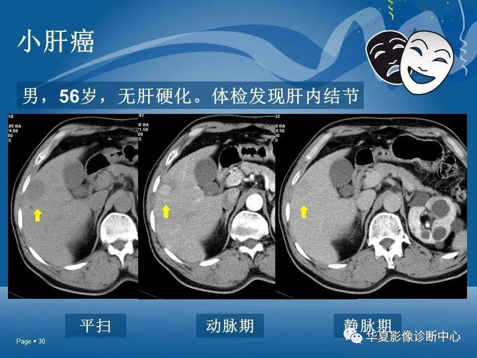 原發性肝細胞癌的ct和mri診斷