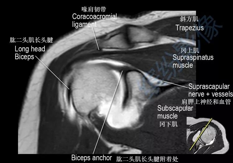 肩关节解剖图mr图片