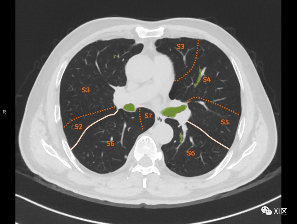 如此詳細的肺部影像解剖有點兒酷
