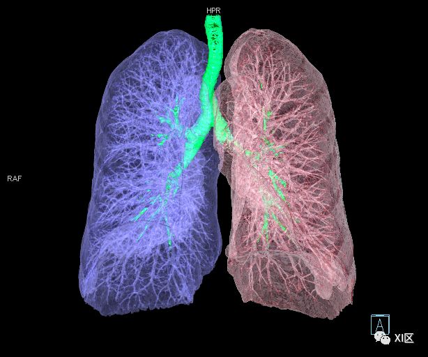 如此详细的肺部影像解剖有点儿酷