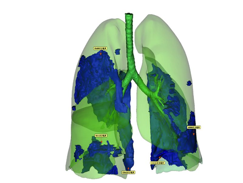 硬核湖南首例3d新冠肺炎模型出炉提供更精准治疗依据