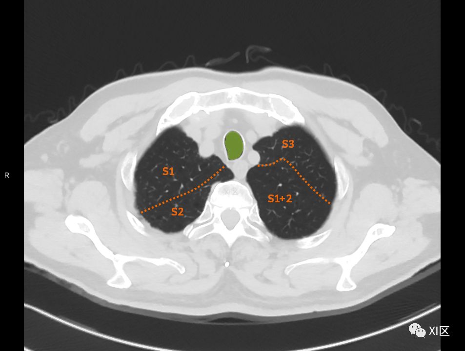 如此详细的肺部影像解剖有点儿酷