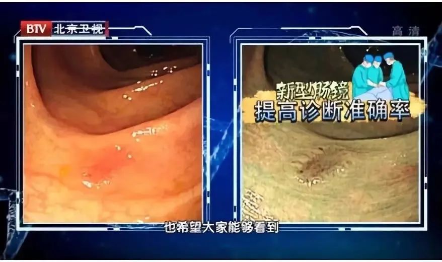 人在坐着的时候,直肠有一个弯折的角度,容易影响直肠或盆腔附近的血液