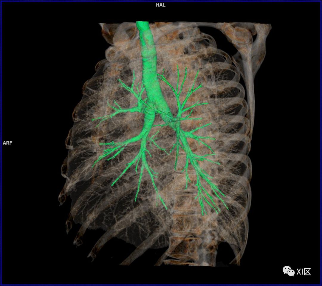 如此详细的肺部影像解剖有点儿酷
