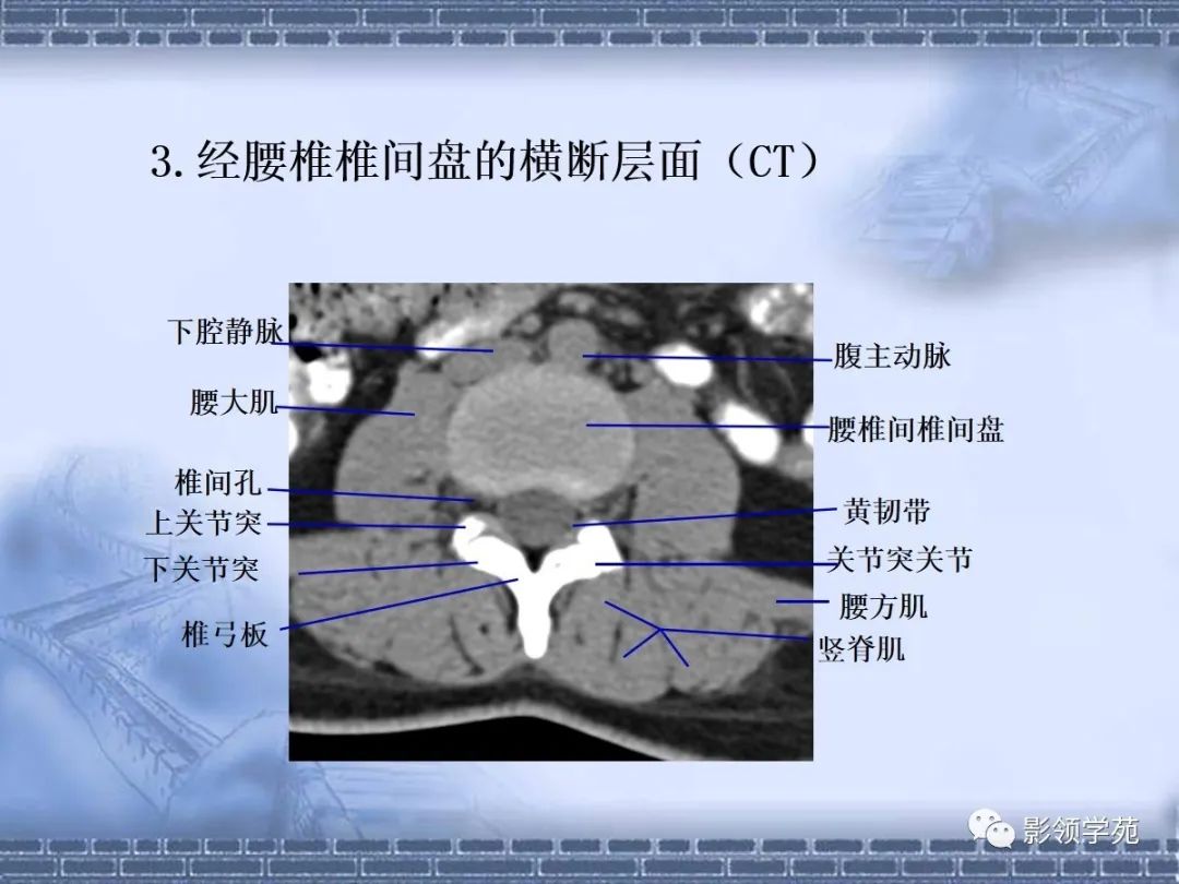 腰椎椎体ct解剖图图片