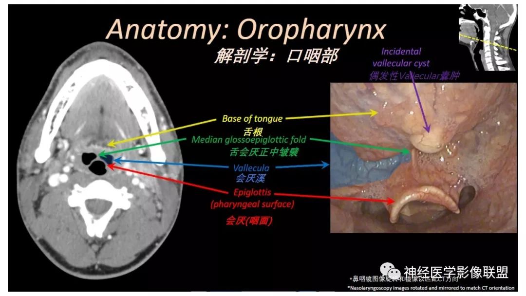 喉部解剖结构图解CT图片